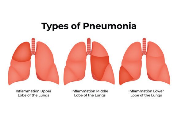 Download Types of Pneumonia Science Design Vector - Sign Collection