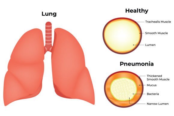 Download Lung Healthy Pneumonia Science Design - Sign Collection